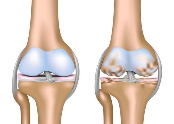 Arthroza