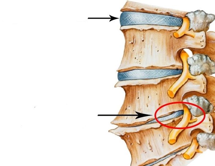 Poškodovan disk in kršeni živce z osteohondrozo materničnega vratu