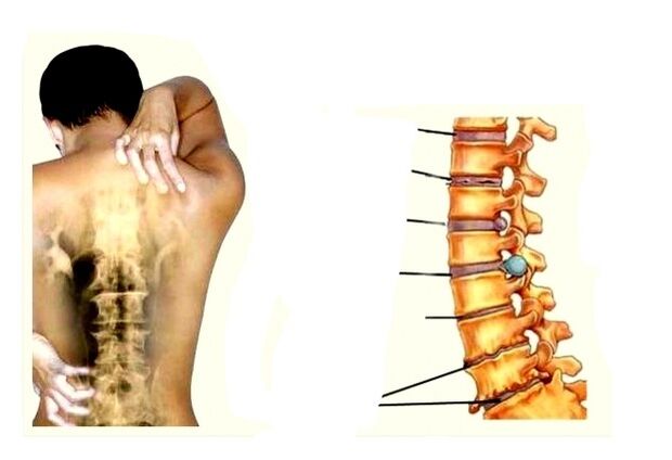 Stopnje razvoja osteohondroze