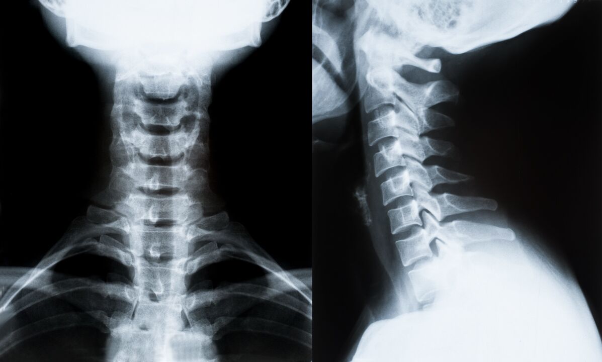 cervikalna osteohondroza na rentgenskem slikanju