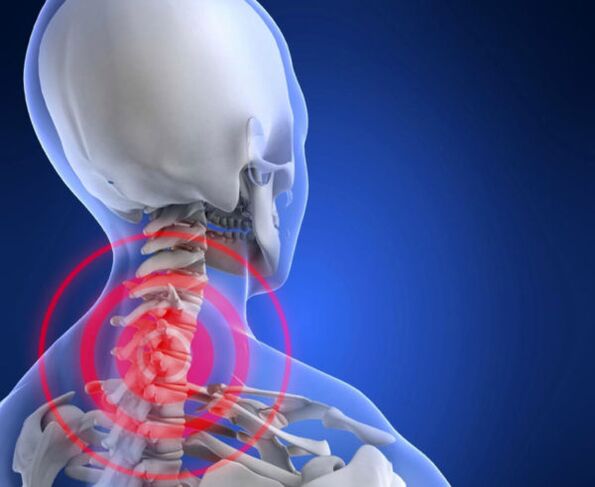 osteohondroza vratne hrbtenice